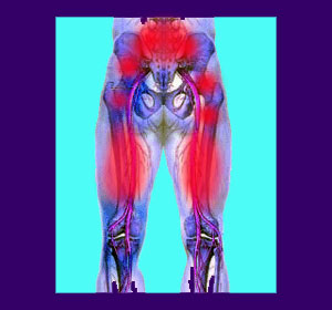 Back Pain from Hamstrings