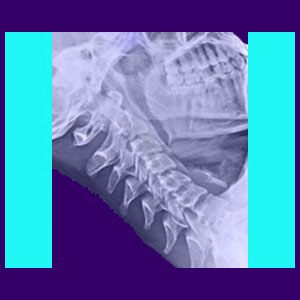 Cervical Spine - Back Pain