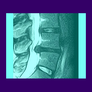 Diagnosis of Herniated Discs - Back Pain
