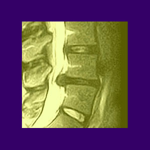 Spinal stenosis and thigh pain image