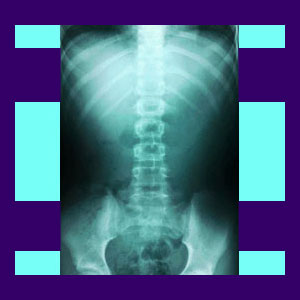 Disc Desiccation Back Pain