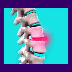 What Are The Symptoms Of Lumbar Discitis? – UUKAMV