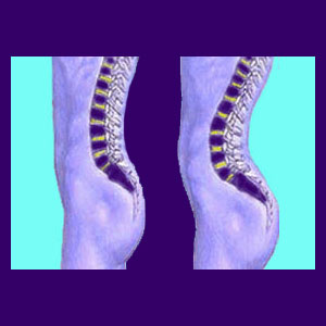 Lordosis