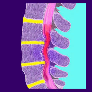 myelomalacia spinal