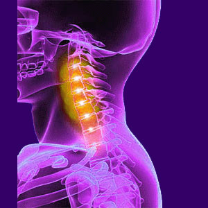 Pinched Nerve in the Neck - Back Pain