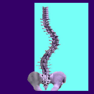 scoliosis