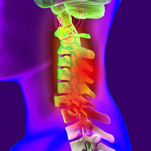 Spinal Cord Hemorrhage