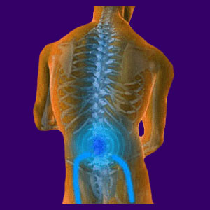Spinal stenosis essay 08 picture